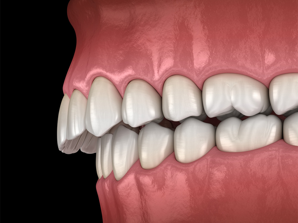 3D illustration of an upper jaw with an overbite, showing the upper teeth significantly overlapping the lower teeth, set against a dark background to emphasize the dental misalignment.