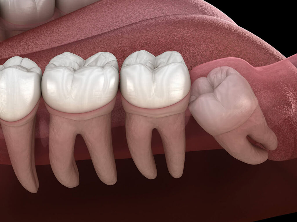 3D illustration showing the impact of impacted wisdom teeth on the gum line in a human mouth, with a focus on one tooth growing at an angle and pushing against its neighbor, set against a dark red background."