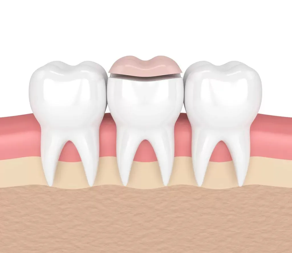 Dental inlays and dental onlays at Kam Dental in Baytown, TX and Humble, TX