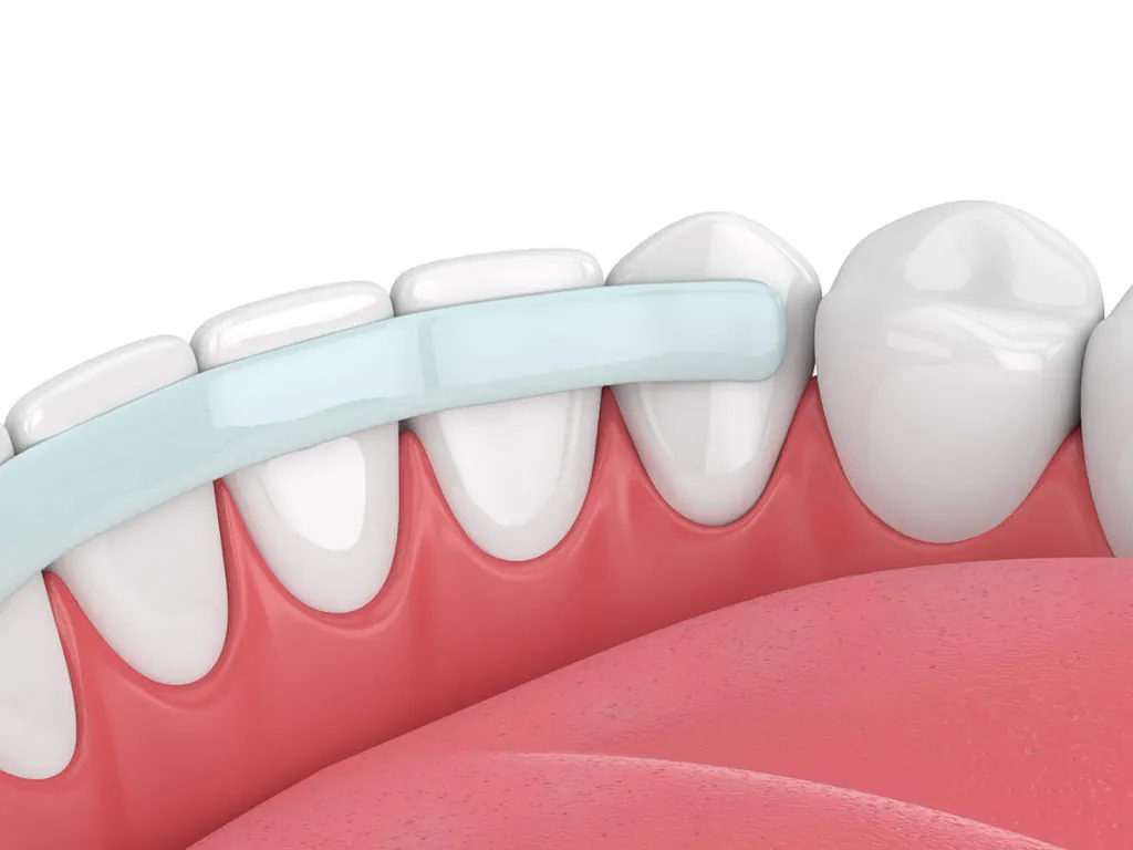 Dental bonding services available at Kam Dental in Baytown, TX and Humble, TX