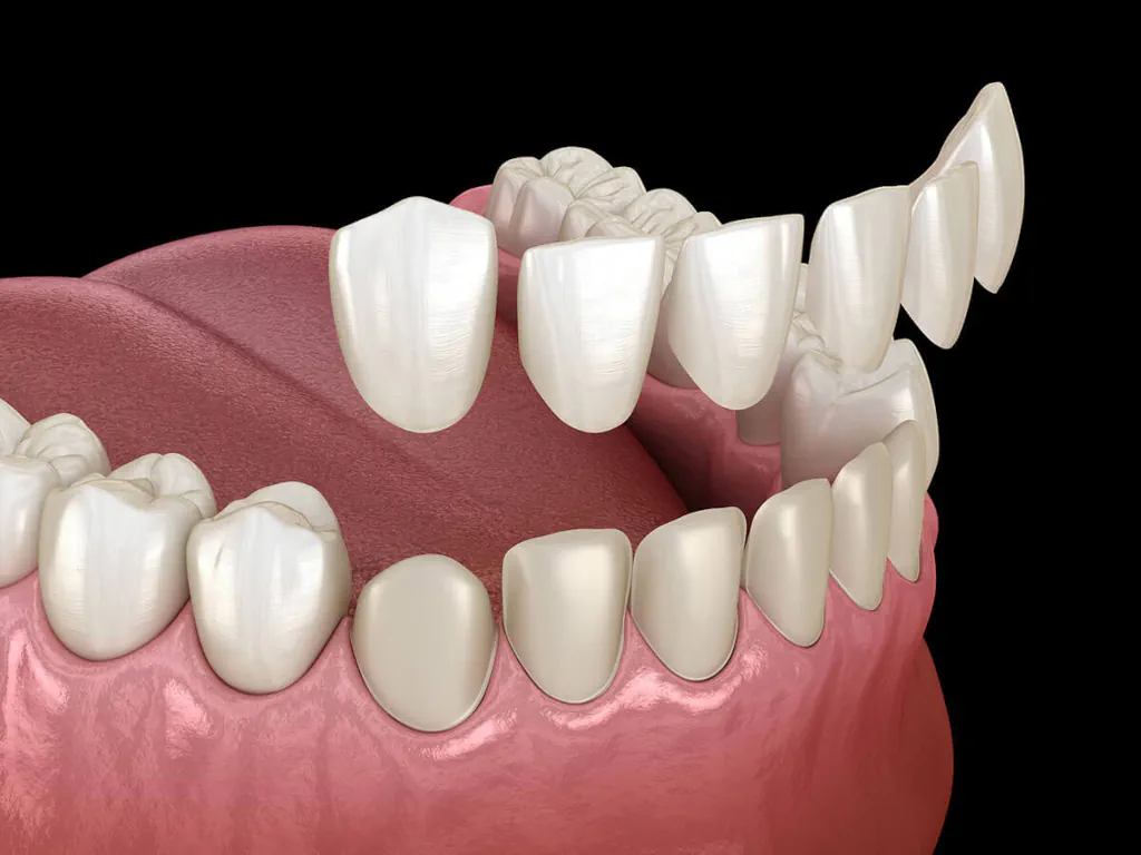 Dental veneers services at Kam Dental in Baytown, TX and Humble, TX