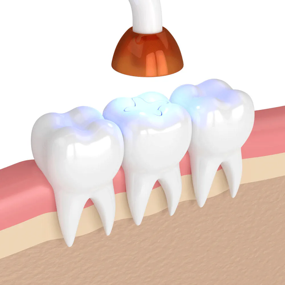 Cavity fillings and sealants available at Kam Dental in Baytown, TX and Humble, TX