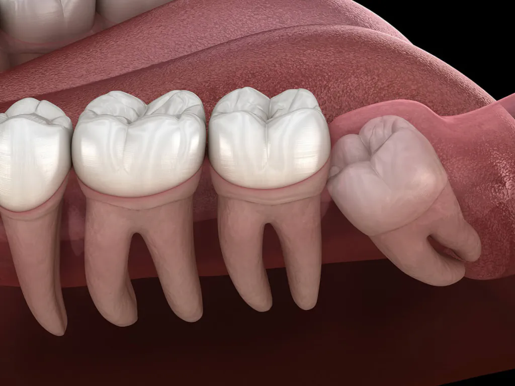 Wisdom teeth removal at Kam Dental in Baytown, TX and Humble, TX